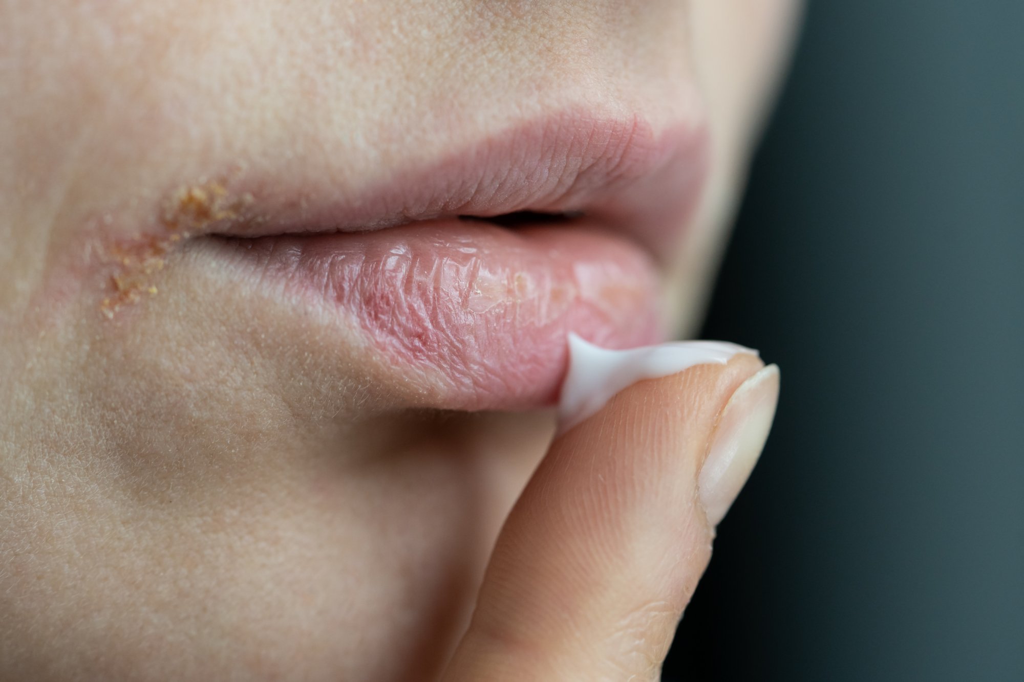 fieberblasen.jpg Eine Hand trägt Lippenpflege auf spröde Lippen auf, sichtbar sind trockene Hautstellen.
